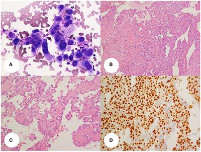 Primary Epithelioid Angiosarcoma of the Thyroid in a Patient Occupationally Exposed to Radiations